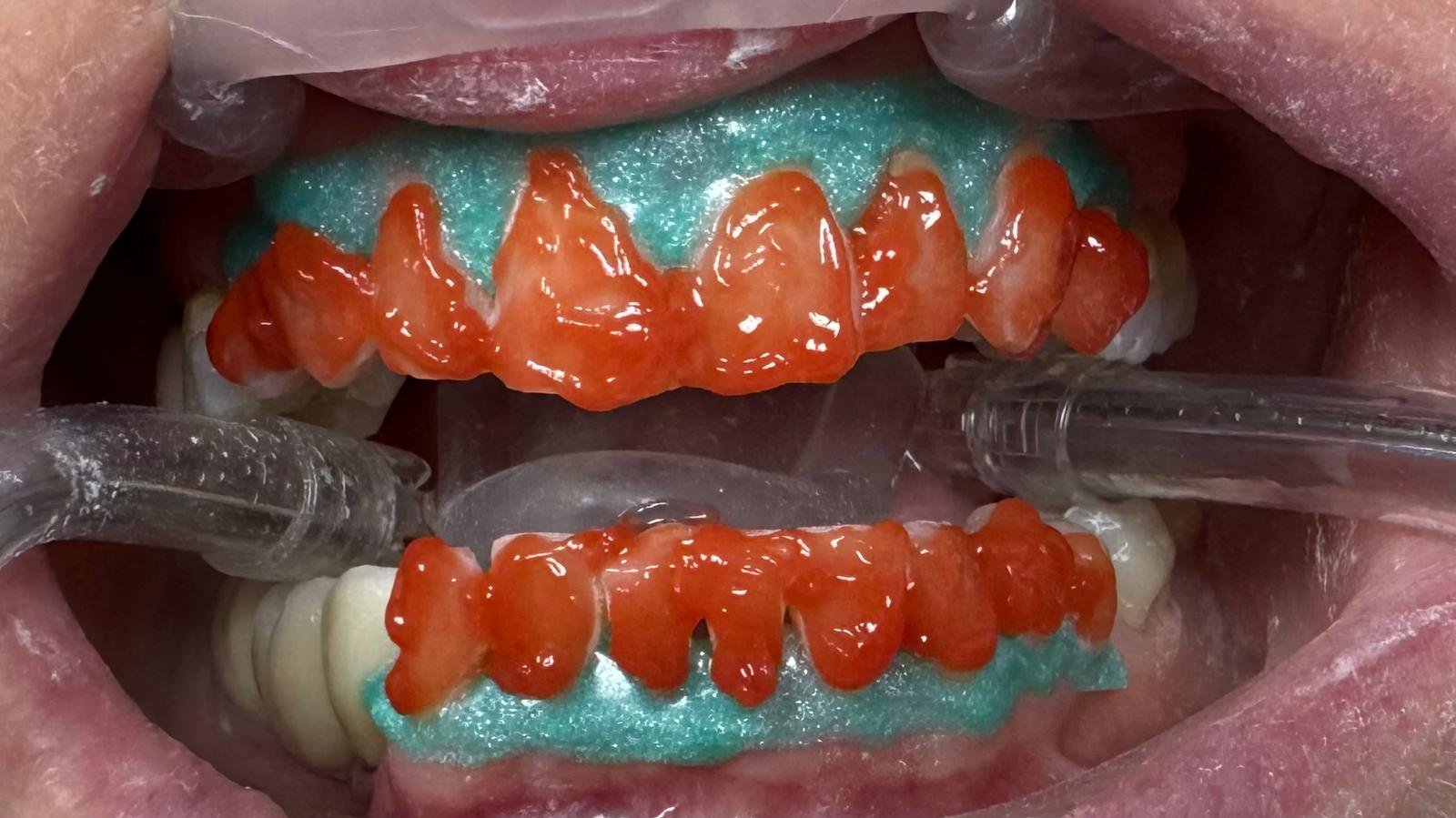 Tratamiento de blanqueamiento dental